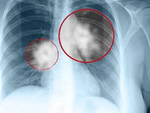 U nang phổi có phải là ung thư không?