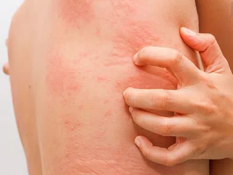 Câu hỏi thường gặp liên quan đến ấu trùng sán lợn