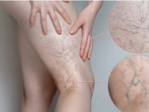 6 yếu tố làm tăng nguy cơ suy giãn tĩnh mạch chân