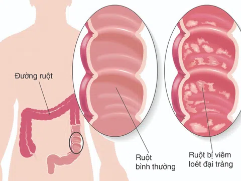 Viêm đại tràng mạn tính có nguy hiểm không?
