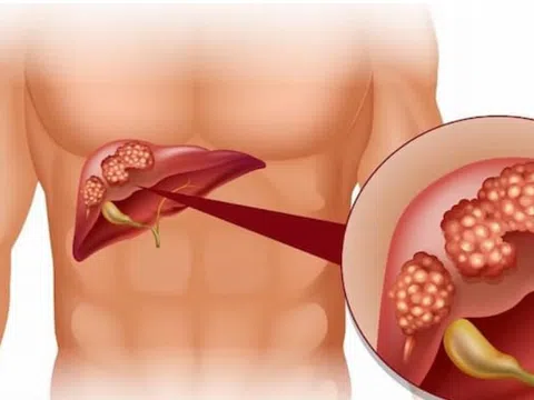 Cách giảm thiểu nguy cơ nhiễm độc gan