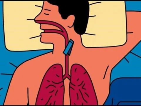 Biểu hiện mắc hội chứng ngưng thở khi ngủ