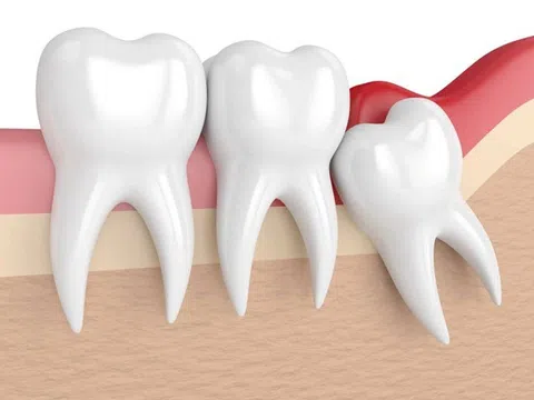 Răng khôn có nên nhổ không?