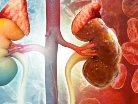 Viêm đài bể thận: Nguyên nhân, triệu chứng, phòng bệnh và cách điều trị