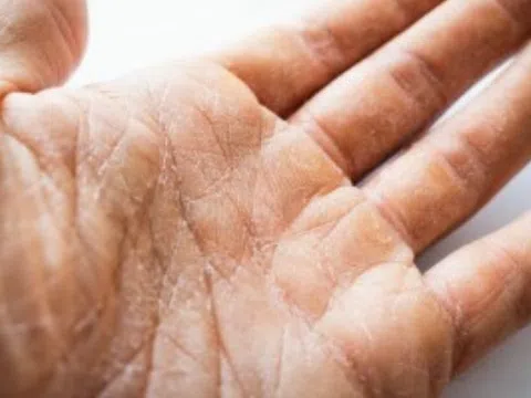 Mẹo chống khô nẻ da tay