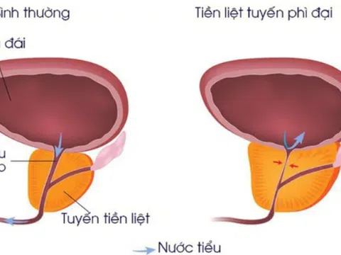 3 điều cần biết về bệnh phì đại tuyến tiền liệt