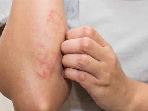 Chữa bệnh chàm nhanh nhất ở Bảo Thanh Đường