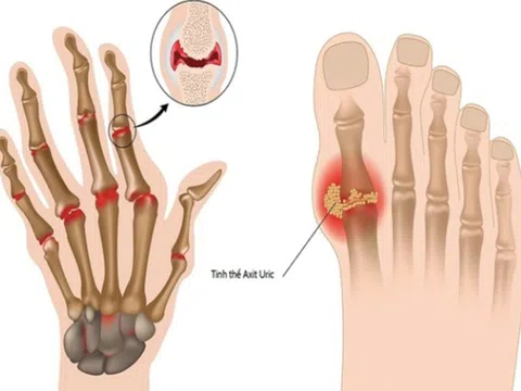 5 cách đào thải axit uric nhanh khỏi cơ thể cần biết