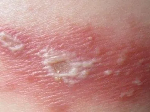 5 biến chứng hay gặp khi mắc bệnh zona thần kinh