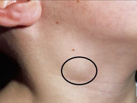 Bệnh lao hạch biểu hiện thế nào, có nguy hiểm không?