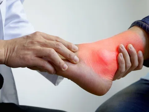6 biến chứng nguy hiểm thường gặp ở bệnh gout