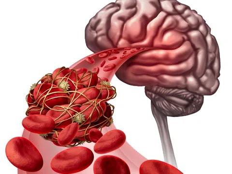 Yếu tố nguy cơ dễ bị đột quỵ mùa lạnh