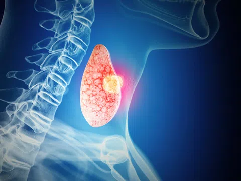 Ung thư tuyến giáp di căn có biểu hiện như thế nào?