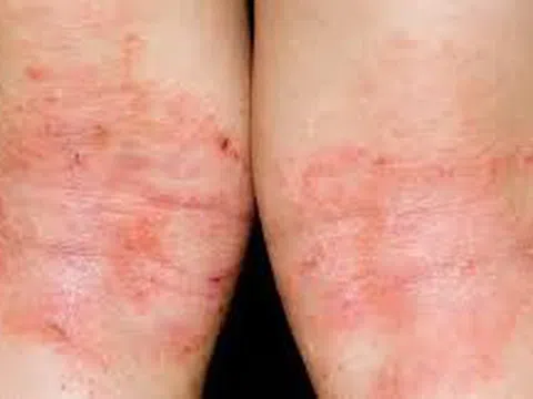 Chữa bệnh chàm bằng Đông y