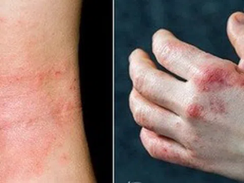 Chữa bệnh chàm bằng Đông y