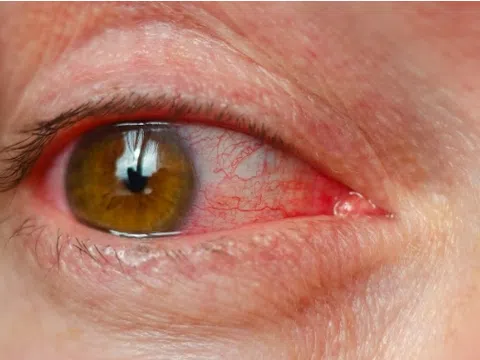 Mắt nhức mỏi là biểu hiện của bệnh gì?