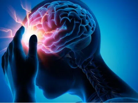 Bé gái bị đau đầu, động kinh, đi khám bác sĩ phát hiện mắc dị dạng mạch máu não