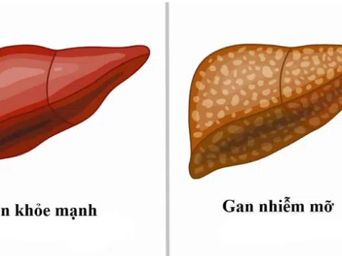 4 dấu hiệu cảnh báo mắc bệnh gan nhiễm mỡ dễ nhận biết