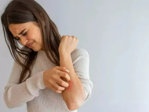 Bệnh vảy nến có lây không?