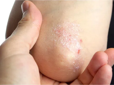 Chữa bệnh vảy nến thể giọt bằng thảo dược