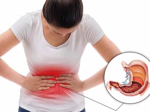 5 bí quyết phòng ngừa bệnh loét dạ dày tá tràng