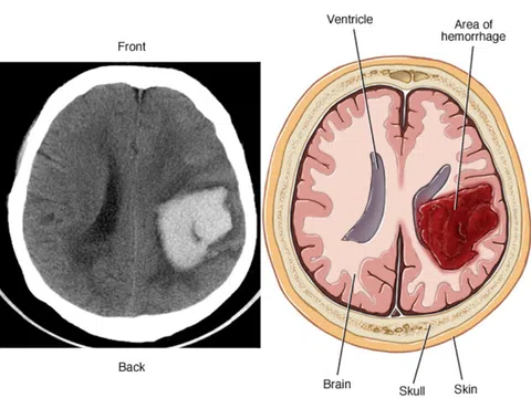 Dị dạng mạch não: Nguyên nhân, triệu chứng, phòng ngừa và điều trị