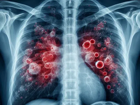 Bệnh nhân suy hô hấp nặng, nguy kịch do lao phổi tái phát