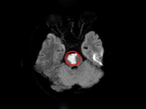 Nam thanh niên 17 tuổi bị đột quỵ
