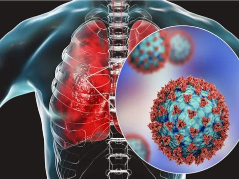 Viêm phổi cấp do đâu, có nguy hiểm không?