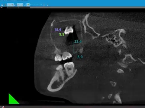 Phẫu thuật lấy răng khôn nằm lạc trong xoang hàm hiếm gặp