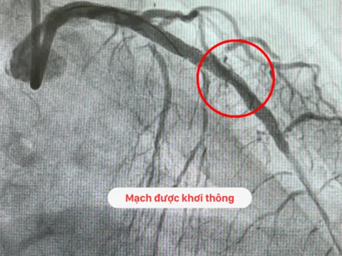 Cứu sống cụ ông 76 tuổi nhồi máu cơ tim, sốc tim, hẹp nặng 3 nhánh mạch vành