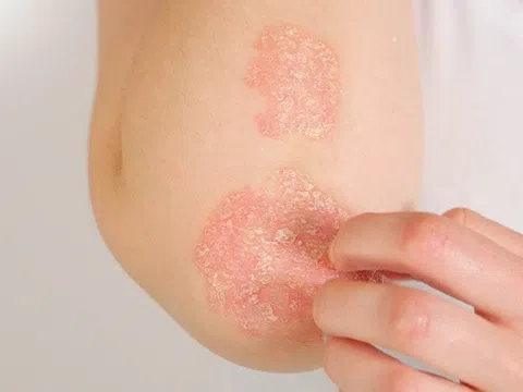 4 lưu ý dùng thuốc giúp kiểm soát bệnh vảy nến thành công
