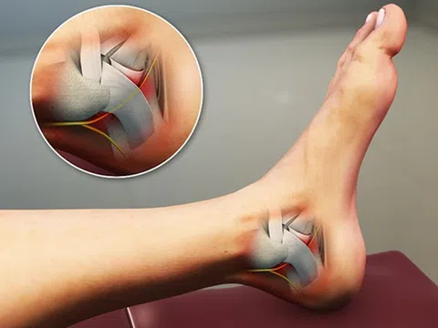 Hội chứng ống cổ chân: Nguyên nhân, biểu hiện, cách điều trị và phòng bệnh