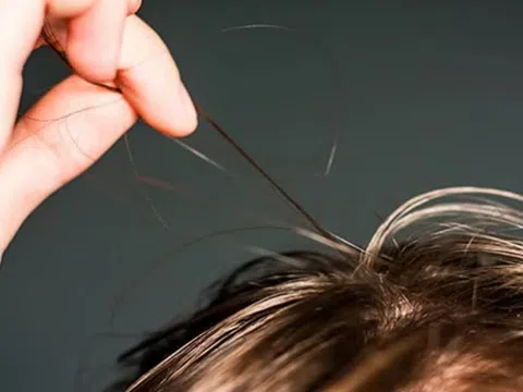 Hội chứng nghiện giật tóc: Nguyên nhân, biểu hiện, cách điều trị và phòng bệnh