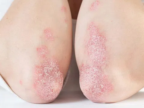 Bệnh vảy nến có lây không? Chuyên gia giải đáp chi tiết!