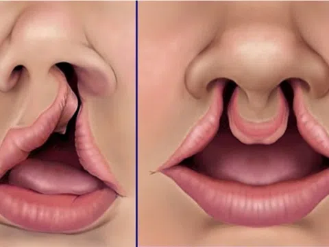 Hở hàm ếch: Nguyên nhân, biểu hiện, cách điều trị và phòng bệnh