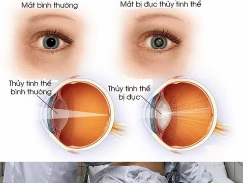 Đục thủy tinh thể bẩm sinh ở trẻ cần phát hiện sớm