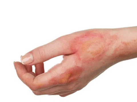 Hội chứng Lyell: Nguyên nhân, biểu hiện, cách điều trị và phòng bệnh