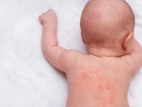 Cách phân biệt phát ban do sởi và phát ban thông thường