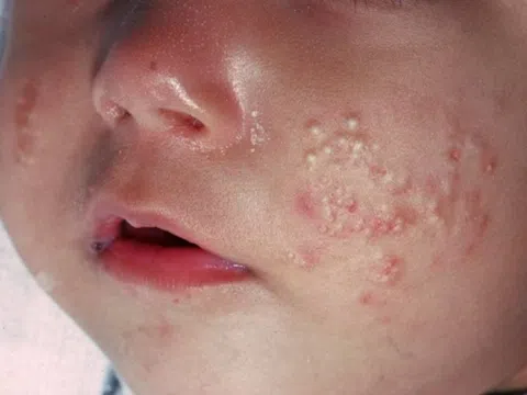 Tại sao trẻ sơ sinh có mụn trứng cá?