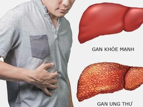 Sỏi túi mật hình thành do đâu? Cách giảm nguy cơ hiệu quả, an toàn