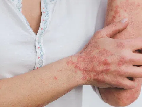 Điều trị sớm bệnh vẩy nến tránh nguy cơ biến chứng