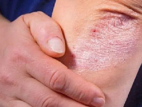 Có nên tự dùng thuốc để chữa bệnh vảy nến?