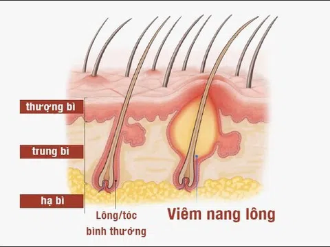 Bảo Thanh Đường - Điều trị dứt điểm bệnh viêm chân tóc