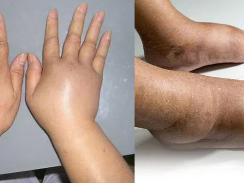 Phù là dấu hiệu của bệnh gì?