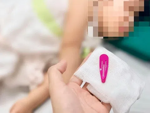 Bé gái 21 tháng tuổi nuốt kẹp tóc vào dạ dày, bác sĩ cảnh báo những thói quen nguy hiểm