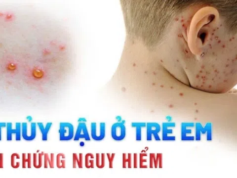 Cứu sống bé sơ sinh 15 ngày tuổi bị thủy đậu biến chứng ác tính