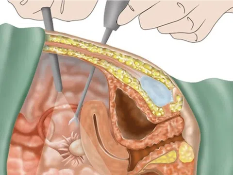 Nguy cơ mang thai ngoài tử cung, vô sinh từ căn bệnh phụ khoa ít triệu chứng