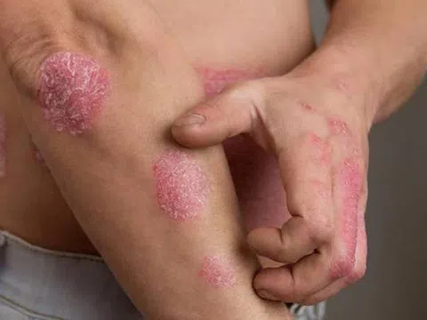 CÁCH CHỮA BỆNH VẢY NẾN LÂU NĂM
