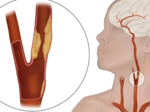 Hẹp động mạch cảnh có cần phẫu thuật không?